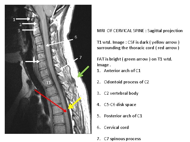 5 1 2 3 MRI OF CERVICAL SPINE : Sagittal projection 6 C 5