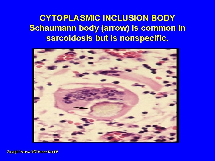 CYTOPLASMIC INCLUSION BODY Schaumann body (arrow) is common in sarcoidosis but is nonspecific. CYTOPLASMIC INCLUSION BODY Schaumann body (arrow) is common in sarcoidosis but is nonspecific.