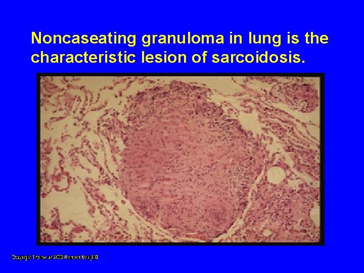 Noncaseating granuloma in lung is the characteristic lesion of sarcoidosis. Noncaseating granuloma in lung is the characteristic lesion of sarcoidosis.