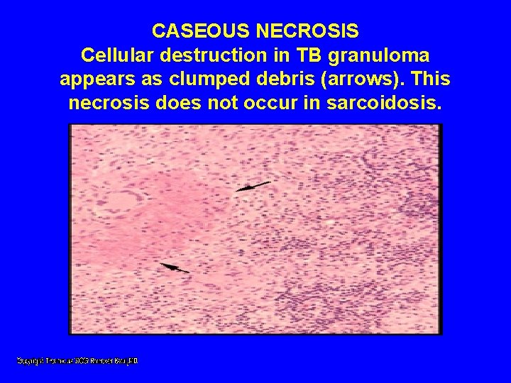 CASEOUS NECROSIS Cellular destruction in TB granuloma appears as clumped debris (arrows). This necrosis CASEOUS NECROSIS Cellular destruction in TB granuloma appears as clumped debris (arrows). This necrosis