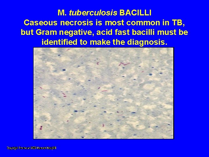 M. tuberculosis BACILLI Caseous necrosis is most common in TB, but Gram negative, acid M. tuberculosis BACILLI Caseous necrosis is most common in TB, but Gram negative, acid