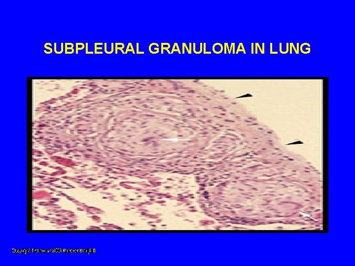 SUBPLEURAL GRANULOMA IN LUNG SUBPLEURAL GRANULOMA IN LUNG