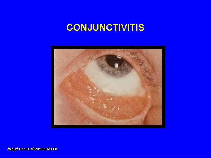CONJUNCTIVITIS CONJUNCTIVITIS