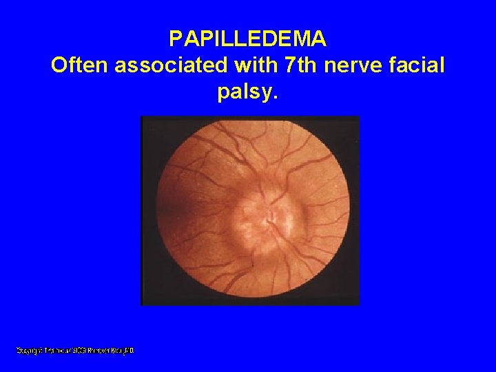 PAPILLEDEMA Often associated with 7 th nerve facial palsy. PAPILLEDEMA Often associated with 7 th nerve facial palsy.