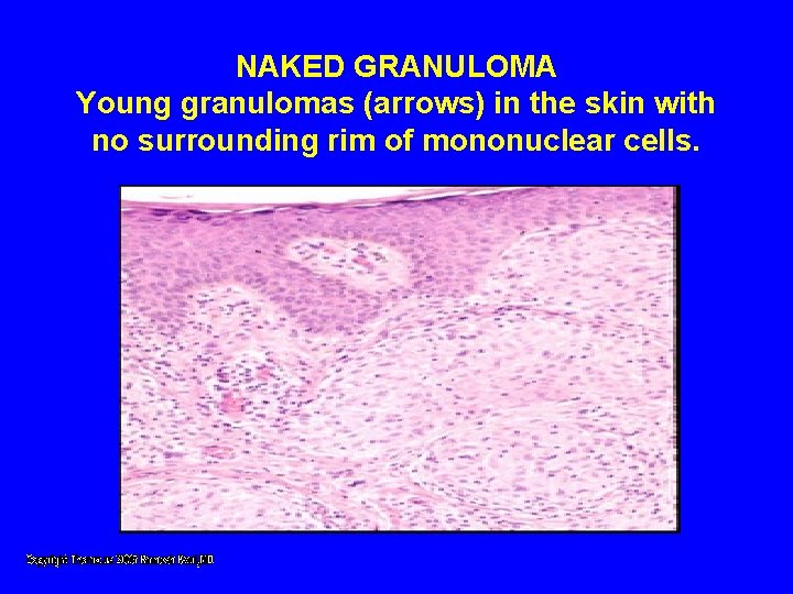 NAKED GRANULOMA Young granulomas (arrows) in the skin with no surrounding rim of mononuclear NAKED GRANULOMA Young granulomas (arrows) in the skin with no surrounding rim of mononuclear