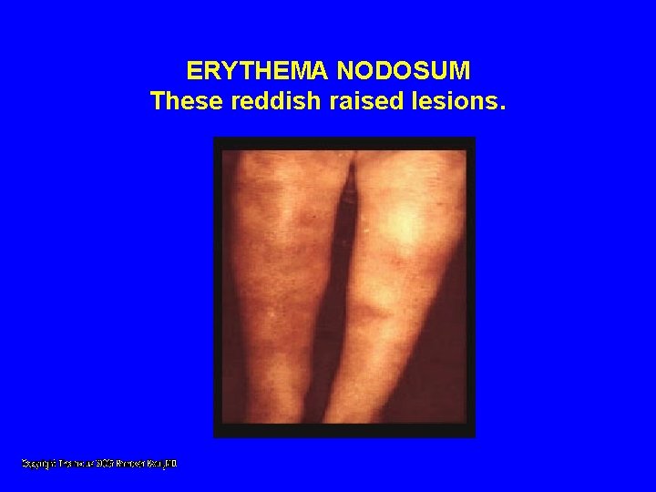 ERYTHEMA NODOSUM These reddish raised lesions. ERYTHEMA NODOSUM These reddish raised lesions.