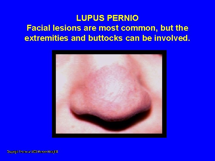 LUPUS PERNIO Facial lesions are most common, but the extremities and buttocks can be LUPUS PERNIO Facial lesions are most common, but the extremities and buttocks can be
