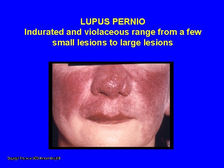 LUPUS PERNIO Indurated and violaceous range from a few small lesions to large lesions LUPUS PERNIO Indurated and violaceous range from a few small lesions to large lesions