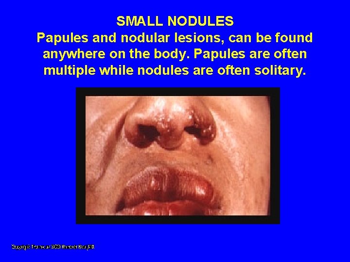 SMALL NODULES Papules and nodular lesions, can be found anywhere on the body. Papules SMALL NODULES Papules and nodular lesions, can be found anywhere on the body. Papules