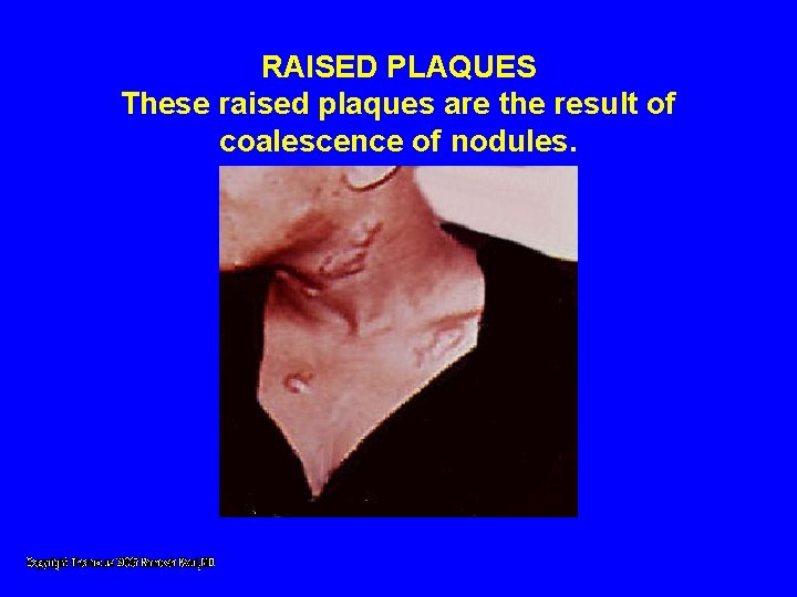 RAISED PLAQUES These raised plaques are the result of coalescence of nodules. RAISED PLAQUES These raised plaques are the result of coalescence of nodules.