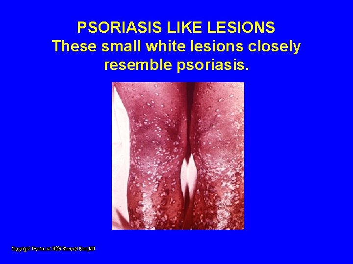 PSORIASIS LIKE LESIONS These small white lesions closely resemble psoriasis. PSORIASIS LIKE LESIONS These small white lesions closely resemble psoriasis.