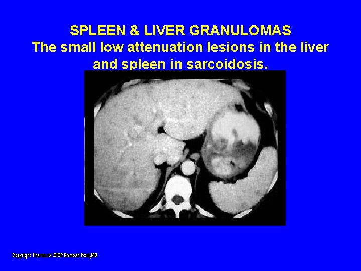 SPLEEN & LIVER GRANULOMAS The small low attenuation lesions in the liver and spleen SPLEEN & LIVER GRANULOMAS The small low attenuation lesions in the liver and spleen