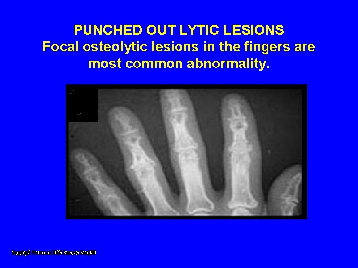 PUNCHED OUT LYTIC LESIONS Focal osteolytic lesions in the fingers are most common abnormality. PUNCHED OUT LYTIC LESIONS Focal osteolytic lesions in the fingers are most common abnormality.