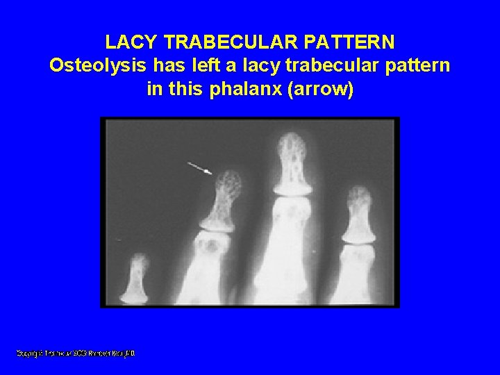 LACY TRABECULAR PATTERN Osteolysis has left a lacy trabecular pattern in this phalanx (arrow) LACY TRABECULAR PATTERN Osteolysis has left a lacy trabecular pattern in this phalanx (arrow)