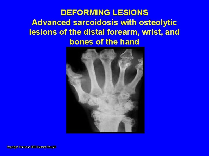DEFORMING LESIONS Advanced sarcoidosis with osteolytic lesions of the distal forearm, wrist, and bones DEFORMING LESIONS Advanced sarcoidosis with osteolytic lesions of the distal forearm, wrist, and bones