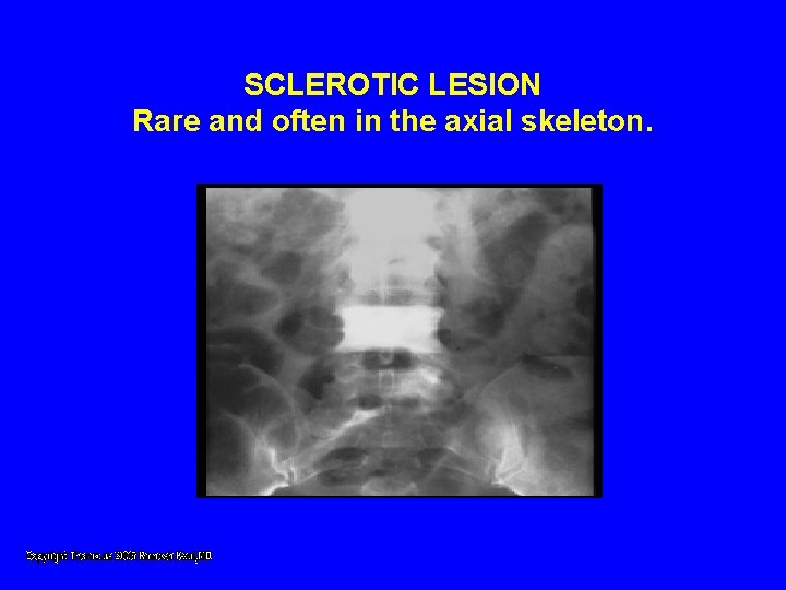 SCLEROTIC LESION Rare and often in the axial skeleton. SCLEROTIC LESION Rare and often in the axial skeleton.