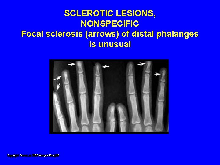 SCLEROTIC LESIONS, NONSPECIFIC Focal sclerosis (arrows) of distal phalanges is unusual SCLEROTIC LESIONS, NONSPECIFIC Focal sclerosis (arrows) of distal phalanges is unusual