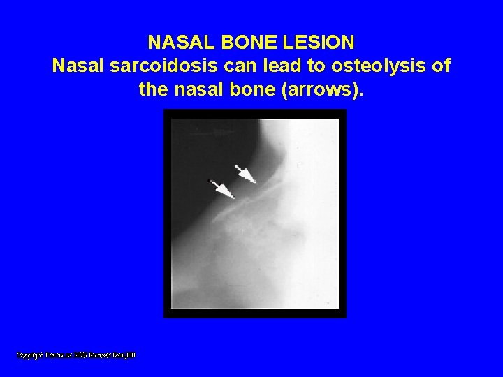 NASAL BONE LESION Nasal sarcoidosis can lead to osteolysis of the nasal bone (arrows). NASAL BONE LESION Nasal sarcoidosis can lead to osteolysis of the nasal bone (arrows).