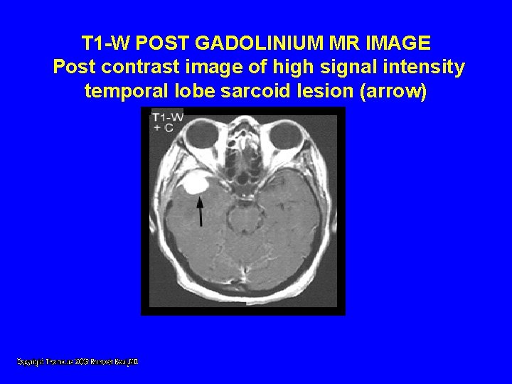 T 1 -W POST GADOLINIUM MR IMAGE Post contrast image of high signal intensity T 1 -W POST GADOLINIUM MR IMAGE Post contrast image of high signal intensity