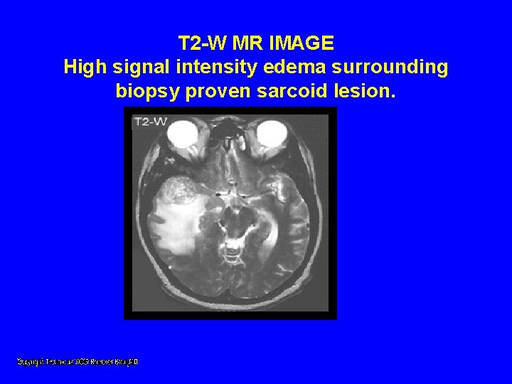 T 2 -W MR IMAGE High signal intensity edema surrounding biopsy proven sarcoid lesion. T 2 -W MR IMAGE High signal intensity edema surrounding biopsy proven sarcoid lesion.