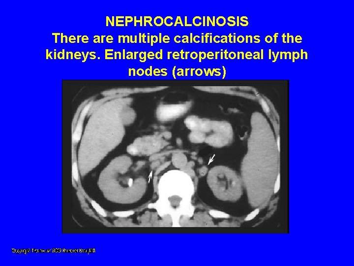 NEPHROCALCINOSIS There are multiple calcifications of the kidneys. Enlarged retroperitoneal lymph nodes (arrows) NEPHROCALCINOSIS There are multiple calcifications of the kidneys. Enlarged retroperitoneal lymph nodes (arrows)