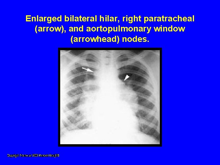 Enlarged bilateral hilar, right paratracheal (arrow), and aortopulmonary window (arrowhead) nodes. Enlarged bilateral hilar, right paratracheal (arrow), and aortopulmonary window (arrowhead) nodes.