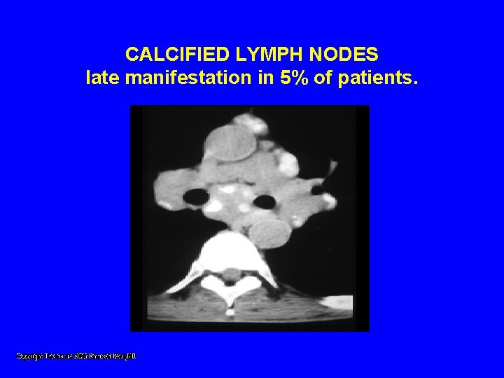 CALCIFIED LYMPH NODES late manifestation in 5% of patients. CALCIFIED LYMPH NODES late manifestation in 5% of patients.