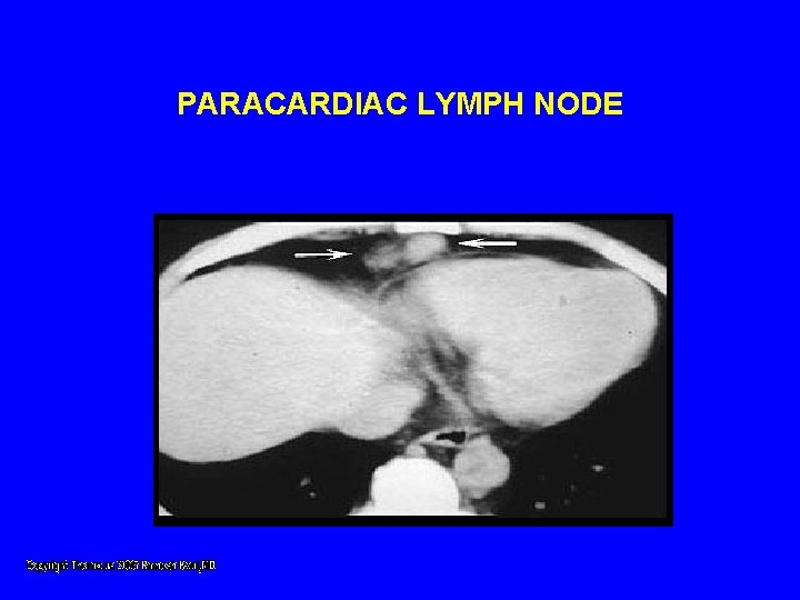 PARACARDIAC LYMPH NODE PARACARDIAC LYMPH NODE