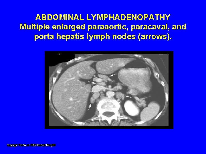 ABDOMINAL LYMPHADENOPATHY Multiple enlarged paraaortic, paracaval, and porta hepatis lymph nodes (arrows). ABDOMINAL LYMPHADENOPATHY Multiple enlarged paraaortic, paracaval, and porta hepatis lymph nodes (arrows).