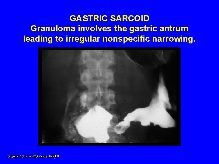 GASTRIC SARCOID Granuloma involves the gastric antrum leading to irregular nonspecific narrowing. GASTRIC SARCOID Granuloma involves the gastric antrum leading to irregular nonspecific narrowing.