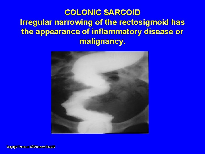 COLONIC SARCOID Irregular narrowing of the rectosigmoid has the appearance of inflammatory disease or COLONIC SARCOID Irregular narrowing of the rectosigmoid has the appearance of inflammatory disease or