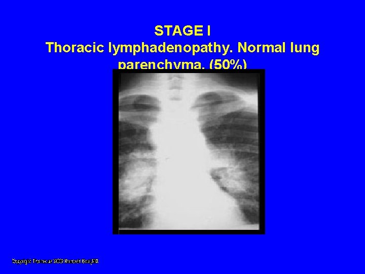 STAGE I Thoracic lymphadenopathy. Normal lung parenchyma. (50%) STAGE I Thoracic lymphadenopathy. Normal lung parenchyma. (50%)