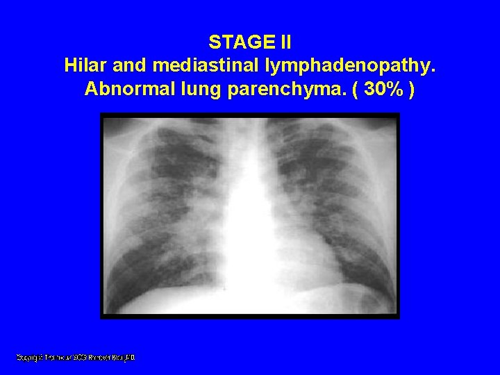 STAGE II Hilar and mediastinal lymphadenopathy. Abnormal lung parenchyma. ( 30% ) STAGE II Hilar and mediastinal lymphadenopathy. Abnormal lung parenchyma. ( 30% )