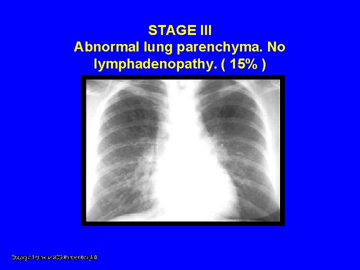 STAGE III Abnormal lung parenchyma. No lymphadenopathy. ( 15% ) STAGE III Abnormal lung parenchyma. No lymphadenopathy. ( 15% )
