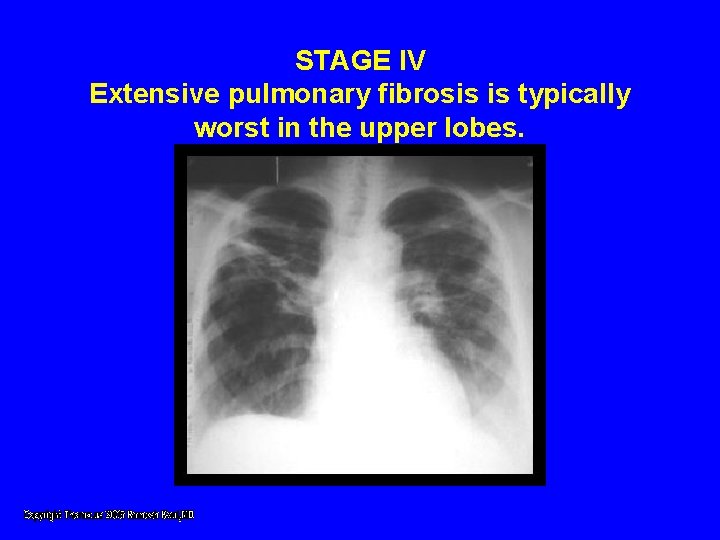 STAGE IV Extensive pulmonary fibrosis is typically worst in the upper lobes. STAGE IV Extensive pulmonary fibrosis is typically worst in the upper lobes.