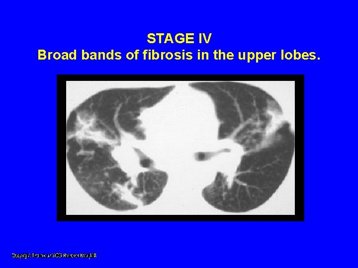 STAGE IV Broad bands of fibrosis in the upper lobes. STAGE IV Broad bands of fibrosis in the upper lobes.