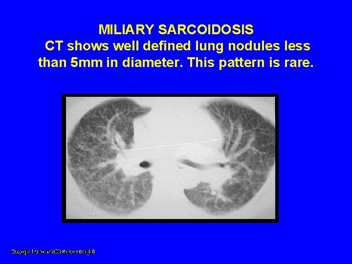 MILIARY SARCOIDOSIS CT shows well defined lung nodules less than 5 mm in diameter. MILIARY SARCOIDOSIS CT shows well defined lung nodules less than 5 mm in diameter.