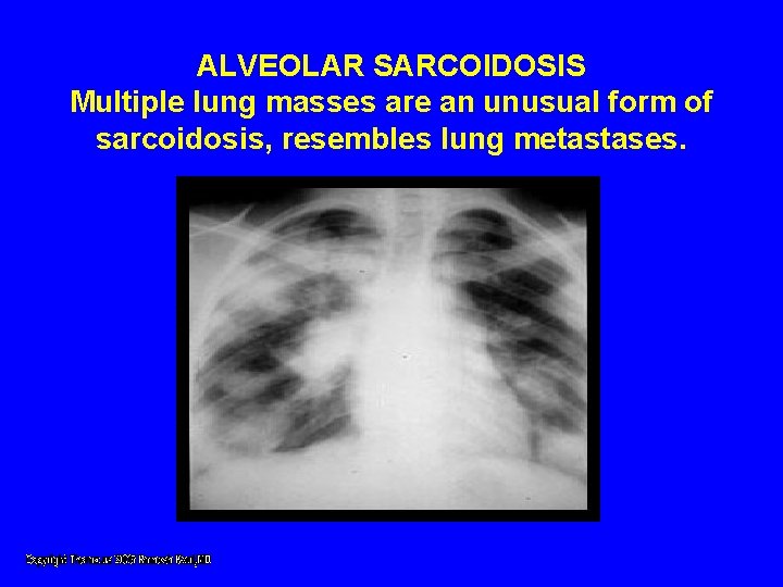 ALVEOLAR SARCOIDOSIS Multiple lung masses are an unusual form of sarcoidosis, resembles lung metastases. ALVEOLAR SARCOIDOSIS Multiple lung masses are an unusual form of sarcoidosis, resembles lung metastases.