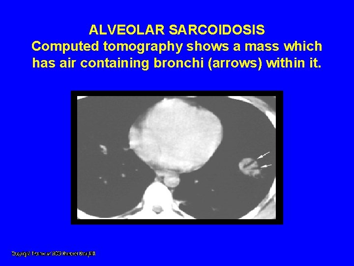 ALVEOLAR SARCOIDOSIS Computed tomography shows a mass which has air containing bronchi (arrows) within ALVEOLAR SARCOIDOSIS Computed tomography shows a mass which has air containing bronchi (arrows) within