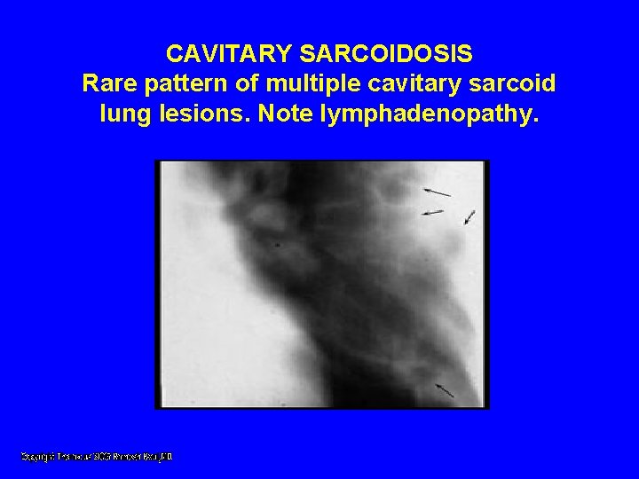 CAVITARY SARCOIDOSIS Rare pattern of multiple cavitary sarcoid lung lesions. Note lymphadenopathy. CAVITARY SARCOIDOSIS Rare pattern of multiple cavitary sarcoid lung lesions. Note lymphadenopathy.