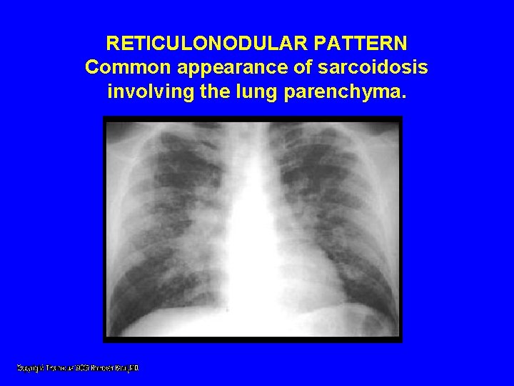 RETICULONODULAR PATTERN Common appearance of sarcoidosis involving the lung parenchyma. RETICULONODULAR PATTERN Common appearance of sarcoidosis involving the lung parenchyma.