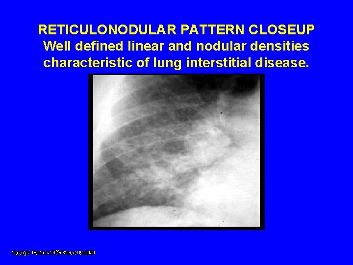 RETICULONODULAR PATTERN CLOSEUP Well defined linear and nodular densities characteristic of lung interstitial disease. RETICULONODULAR PATTERN CLOSEUP Well defined linear and nodular densities characteristic of lung interstitial disease.