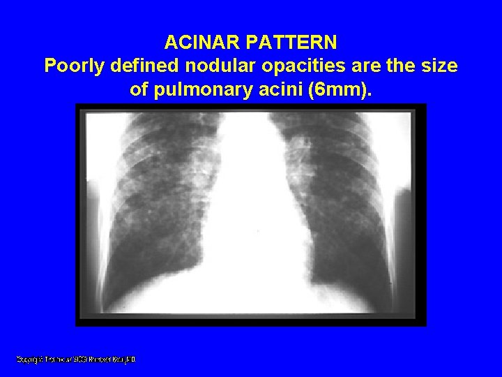 ACINAR PATTERN Poorly defined nodular opacities are the size of pulmonary acini (6 mm). ACINAR PATTERN Poorly defined nodular opacities are the size of pulmonary acini (6 mm).