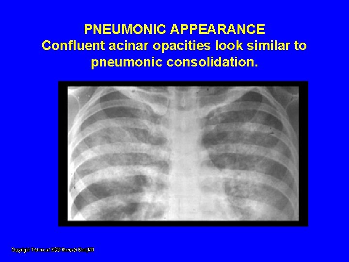 PNEUMONIC APPEARANCE Confluent acinar opacities look similar to pneumonic consolidation. PNEUMONIC APPEARANCE Confluent acinar opacities look similar to pneumonic consolidation.
