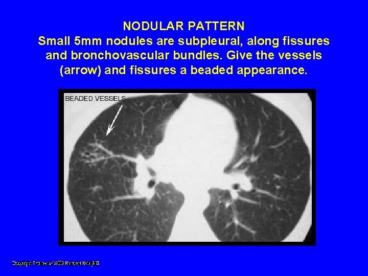 NODULAR PATTERN Small 5 mm nodules are subpleural, along fissures and bronchovascular bundles. Give NODULAR PATTERN Small 5 mm nodules are subpleural, along fissures and bronchovascular bundles. Give