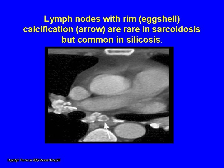 Lymph nodes with rim (eggshell) calcification (arrow) are rare in sarcoidosis but common in Lymph nodes with rim (eggshell) calcification (arrow) are rare in sarcoidosis but common in