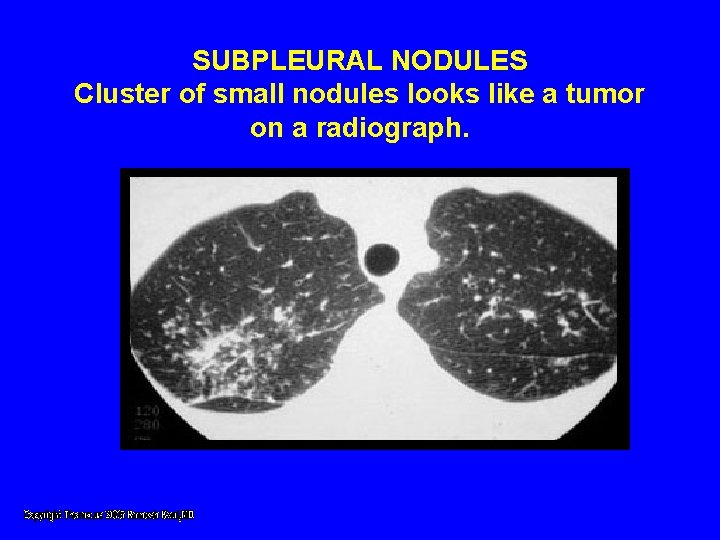 SUBPLEURAL NODULES Cluster of small nodules looks like a tumor on a radiograph. SUBPLEURAL NODULES Cluster of small nodules looks like a tumor on a radiograph.