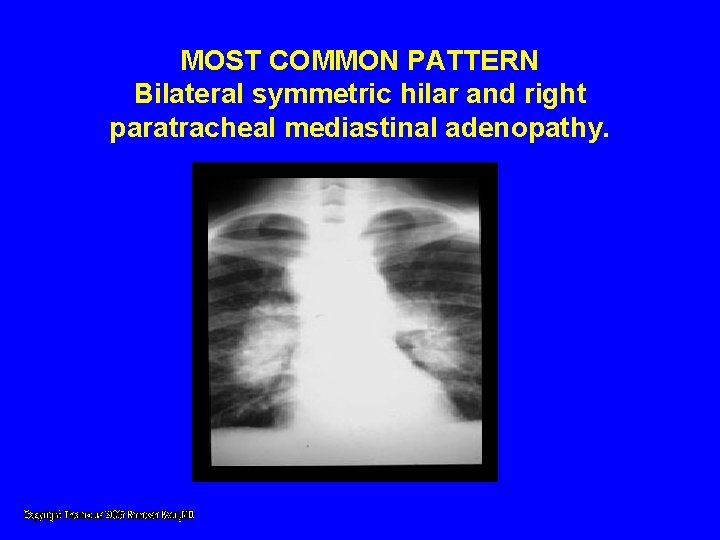 MOST COMMON PATTERN Bilateral symmetric hilar and right paratracheal mediastinal adenopathy. MOST COMMON PATTERN Bilateral symmetric hilar and right paratracheal mediastinal adenopathy.
