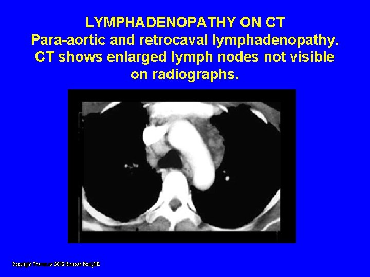 LYMPHADENOPATHY ON CT Para-aortic and retrocaval lymphadenopathy. CT shows enlarged lymph nodes not visible LYMPHADENOPATHY ON CT Para-aortic and retrocaval lymphadenopathy. CT shows enlarged lymph nodes not visible