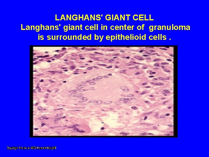 LANGHANS' GIANT CELL Langhans' giant cell in center of granuloma is surrounded by epithelioid LANGHANS' GIANT CELL Langhans' giant cell in center of granuloma is surrounded by epithelioid